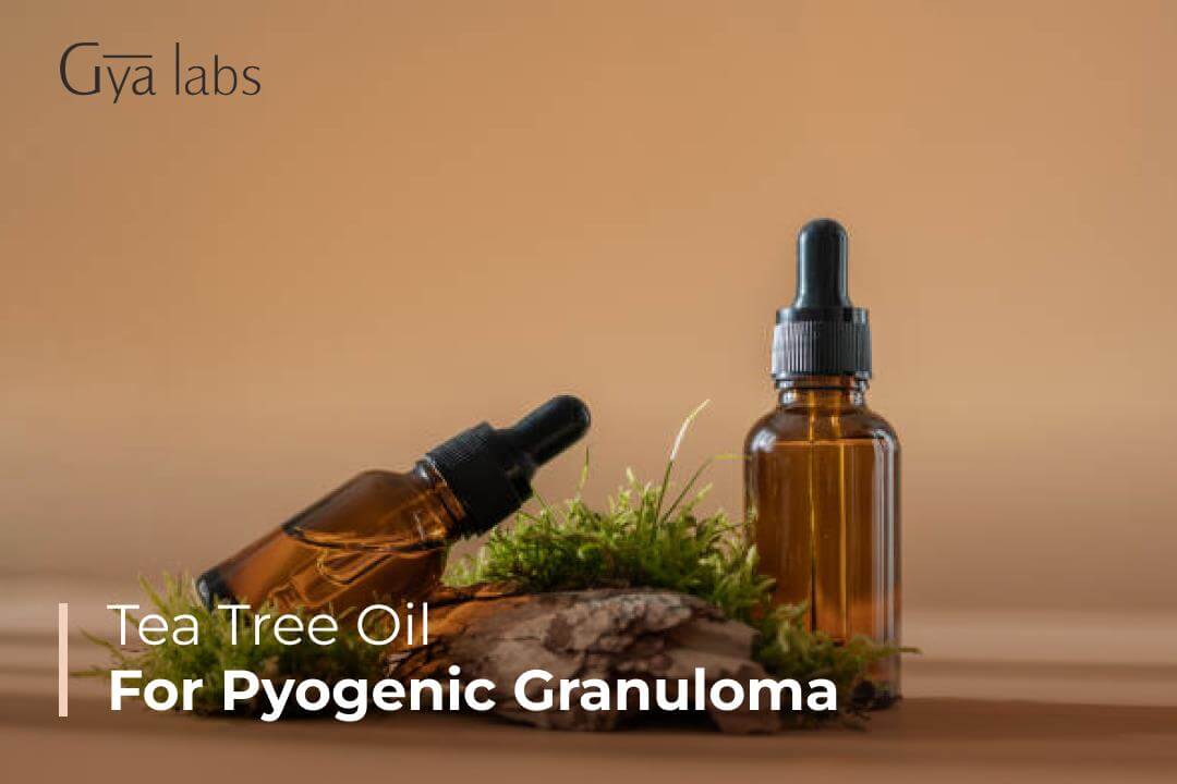 Treat Pyogenic Granuloma Using Tea Tree Oil