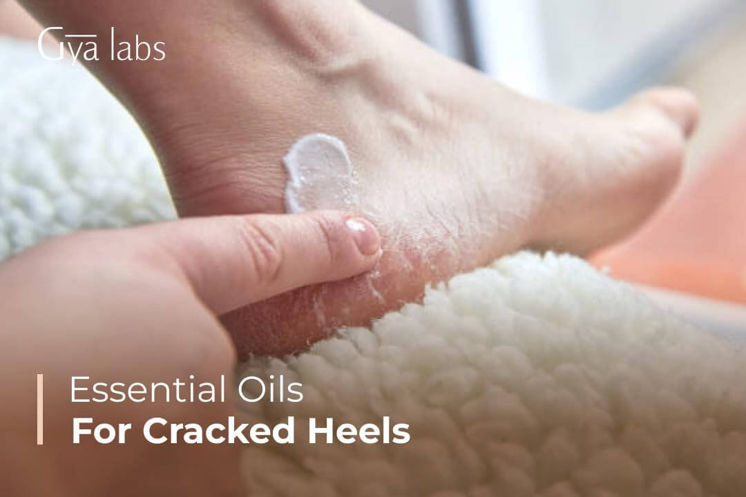 How to Heal Cracked Feet and Dry Heels With Essential Oils - Bellatory